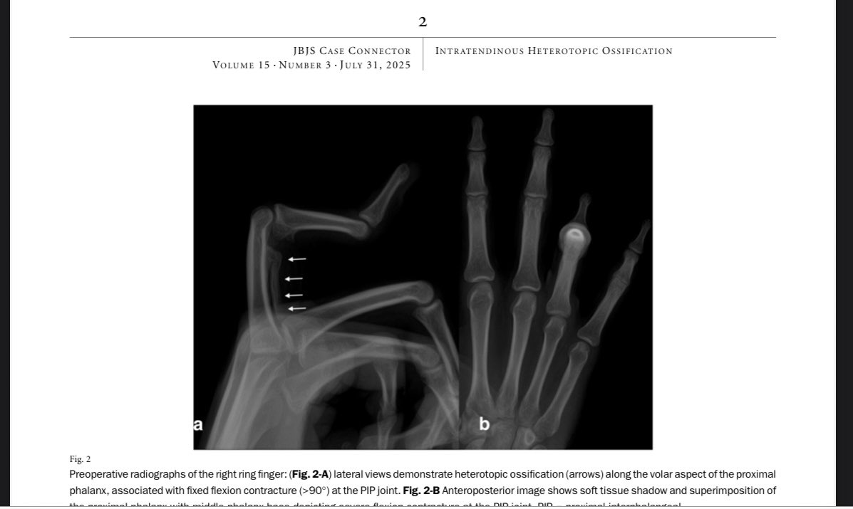 Terrence Jose Jerome, FRCS (@terrencejose) on Twitter photo Just Published in JBJS
A rare case of intratendinous heterotopic ossification in FDS tendon successfully treated with surgery& rehab.
journals.lww.com/jbjscc/abstrac… <a href="/JHandSurg/">J Hand Surg Am- ASSH</a> <a href="/BSSHand/">British Society for Surgery of the Hand</a> <a href="/JHSEur/">The Journal of Hand Surgery (European Volume)</a> <a href="/jbjs/">J Bone & Joint Surg</a> <a href="/BoneJointJ/">The Bone & Joint Journal</a> <a href="/FESSHEurope/">FESSH</a> <a href="/prsjournal/">Plastic and Reconstructive Surgery</a> <a href="/PRSGlobalOpen/">PRS Global Open</a> <a href="/AAOS1/">AAOS</a> <a href="/JHSGlobalOnline/">JHS GO</a> <a href="/SICOTortho/">SICOT</a> Just Published in JBJS
A rare case of intratendinous heterotopic ossification in FDS tendon successfully treated with surgery& rehab.
journals.lww.com/jbjscc/abstrac… <a href="/JHandSurg/">J Hand Surg Am- ASSH</a> <a href="/BSSHand/">British Society for Surgery of the Hand</a> <a href="/JHSEur/">The Journal of Hand Surgery (European Volume)</a> <a href="/jbjs/">J Bone & Joint Surg</a> <a href="/BoneJointJ/">The Bone & Joint Journal</a> <a href="/FESSHEurope/">FESSH</a> <a href="/prsjournal/">Plastic and Reconstructive Surgery</a> <a href="/PRSGlobalOpen/">PRS Global Open</a> <a href="/AAOS1/">AAOS</a> <a href="/JHSGlobalOnline/">JHS GO</a> <a href="/SICOTortho/">SICOT</a>