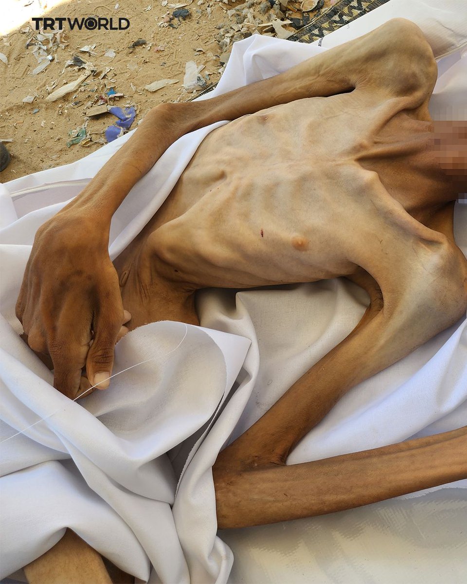 trtworld's tweet photo. 27-year-old Adil Mazi, who died of severe malnutrition in Khan Younis, Gaza, on July 31. His death comes amid worsening food shortages caused by the ongoing Israeli blockade on Gaza https://t.co/5zRuNlsPBm