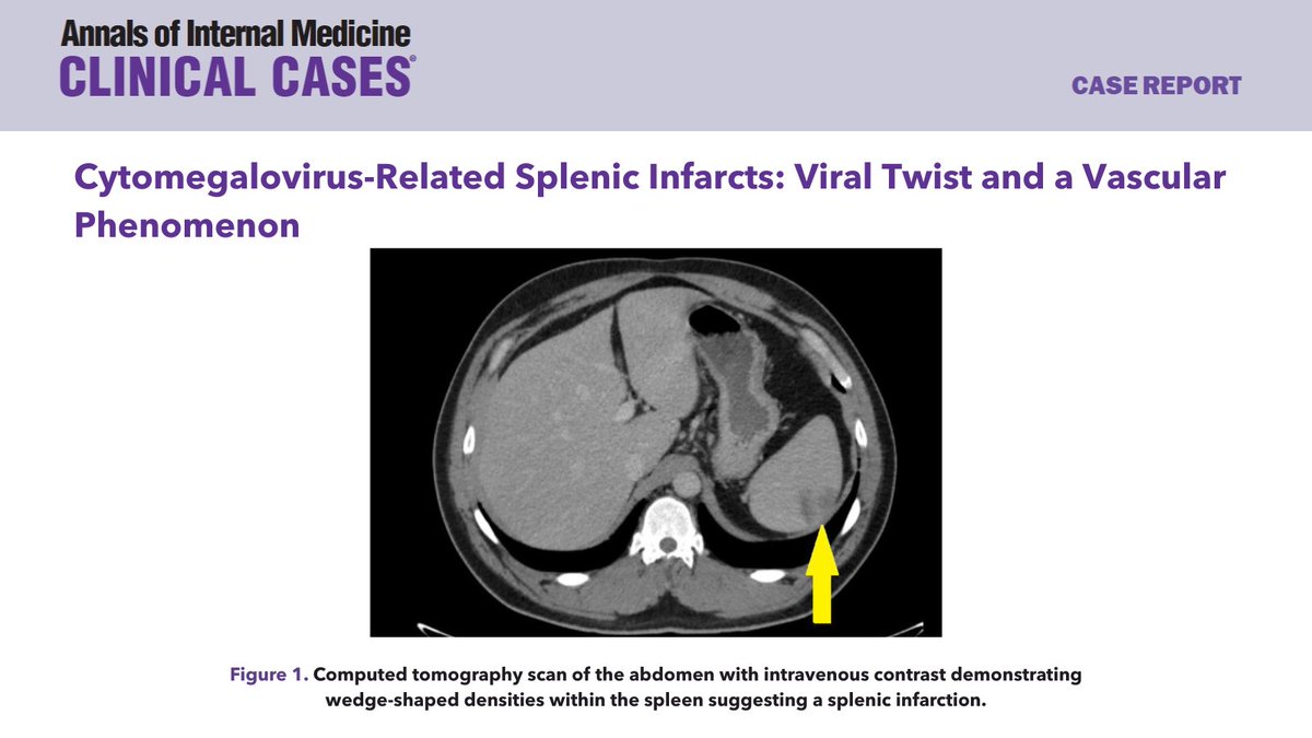 Annals of Internal Medicine: Clinical Cases (@annalsofimcc) on Twitter photo Researchers present a unique case of acute Cytomegalovirus infection in a 35-year-old healthy individual who is immunocompetent and who developed the rare complication of isolated splenic infarction. bit.ly/45cDwSV <a href="/AHAScience/">AHA Science</a> #AHAJournals Researchers present a unique case of acute Cytomegalovirus infection in a 35-year-old healthy individual who is immunocompetent and who developed the rare complication of isolated splenic infarction. bit.ly/45cDwSV <a href="/AHAScience/">AHA Science</a> #AHAJournals