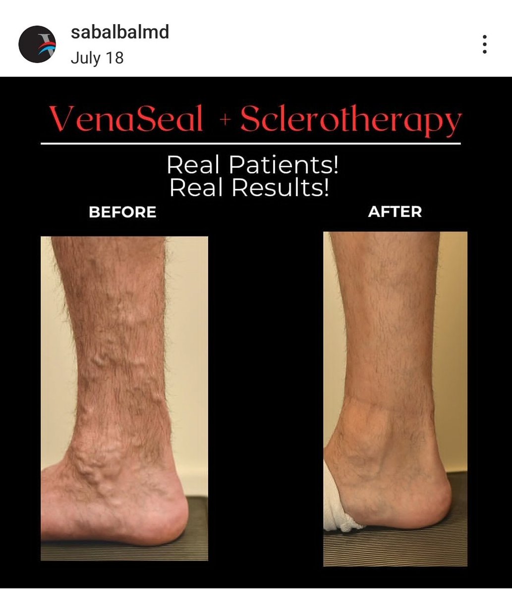 Sabalbal MD (@mahersabalbal) on Twitter photo Bye bye painful varicosities. SSV and GSV ablation with VenaSeal followed by foam sclerotherapy <a href="/VenousForum/">American Venous Forum | AVF</a> <a href="/VaricoseVeinFix/">Varicose Veins Fix</a> <a href="/VenousSymposium/">Venous Symposium</a> <a href="/VascularSVS/">Society for Vascular Surgery</a> Bye bye painful varicosities. SSV and GSV ablation with VenaSeal followed by foam sclerotherapy <a href="/VenousForum/">American Venous Forum | AVF</a> <a href="/VaricoseVeinFix/">Varicose Veins Fix</a> <a href="/VenousSymposium/">Venous Symposium</a> <a href="/VascularSVS/">Society for Vascular Surgery</a>