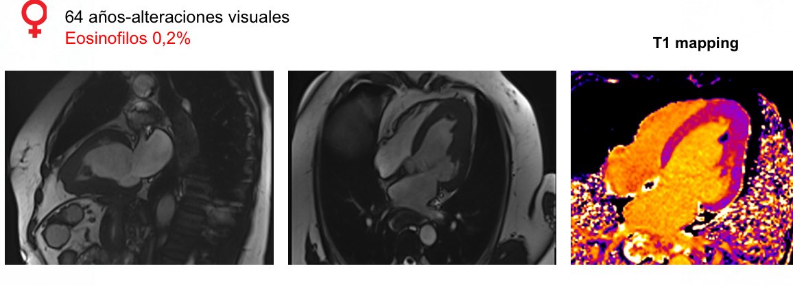 sdelcastillo84's tweet image. Muy interesante @LopezOpitz !! Hace poco vimos un caso muy parecido 👇
Podremos ver ecg 🤔?
PD las dudas siguen al día de hoy
