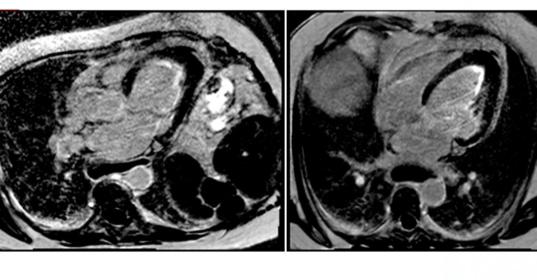 sdelcastillo84's tweet image. Muy interesante @LopezOpitz !! Hace poco vimos un caso muy parecido 👇
Podremos ver ecg 🤔?
PD las dudas siguen al día de hoy