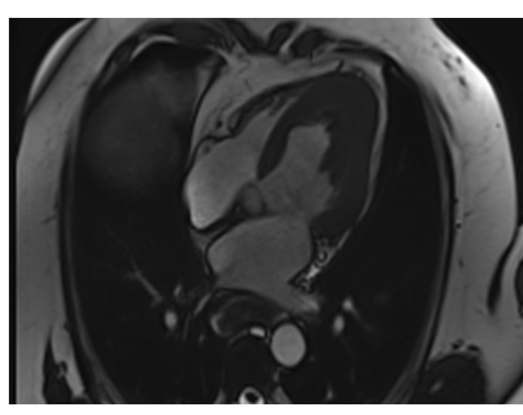 Santiago del Castillo (@sdelcastillo84) on Twitter photo <a href="/LopezOpitz/">J.Lopez-Opitz@CardioImagen_cl</a> <a href="/ClinicaIndisa/">Clínica INDISA</a> <a href="/cshenoy3/">Chetan Shenoy</a> <a href="/DrFuisz/">Dr. Anthon Fuisz, MD</a> <a href="/purviparwani/">Dr. Purvi Parwani</a> <a href="/ImagenCardiaca/">SEIC - Sociedad Española de Imagen Cardíaca</a> <a href="/SCMRorg/">Society for Cardiovascular Magnetic Resonance</a> <a href="/iamritu/">Ritu Thamman MD</a> <a href="/_RoBlanco/">Rocío Blanco, MD 🇦🇷</a> <a href="/CardioMDPhD/">Leandro Slipczuk</a> <a href="/pfelissamburu/">Pablo Elissamburu 🇦🇷</a> <a href="/MAecocardio/">MA Garcia Fernandez</a> <a href="/TomoResoSac/">@Tc-rmn-sac</a> <a href="/filikinetico/">Eduardo Filipini</a> <a href="/SAC_54/">Sociedad Argentina de Cardiología</a> Muy interesante <a href="/LopezOpitz/">J.Lopez-Opitz@CardioImagen_cl</a> !! Hace poco vimos un caso muy parecido 👇
Podremos ver ecg 🤔?
PD las dudas siguen al día de hoy <a href="/LopezOpitz/">J.Lopez-Opitz@CardioImagen_cl</a> <a href="/ClinicaIndisa/">Clínica INDISA</a> <a href="/cshenoy3/">Chetan Shenoy</a> <a href="/DrFuisz/">Dr. Anthon Fuisz, MD</a> <a href="/purviparwani/">Dr. Purvi Parwani</a> <a href="/ImagenCardiaca/">SEIC - Sociedad Española de Imagen Cardíaca</a> <a href="/SCMRorg/">Society for Cardiovascular Magnetic Resonance</a> <a href="/iamritu/">Ritu Thamman MD</a> <a href="/_RoBlanco/">Rocío Blanco, MD 🇦🇷</a> <a href="/CardioMDPhD/">Leandro Slipczuk</a> <a href="/pfelissamburu/">Pablo Elissamburu 🇦🇷</a> <a href="/MAecocardio/">MA Garcia Fernandez</a> <a href="/TomoResoSac/">@Tc-rmn-sac</a> <a href="/filikinetico/">Eduardo Filipini</a> <a href="/SAC_54/">Sociedad Argentina de Cardiología</a> Muy interesante <a href="/LopezOpitz/">J.Lopez-Opitz@CardioImagen_cl</a> !! Hace poco vimos un caso muy parecido 👇
Podremos ver ecg 🤔?
PD las dudas siguen al día de hoy