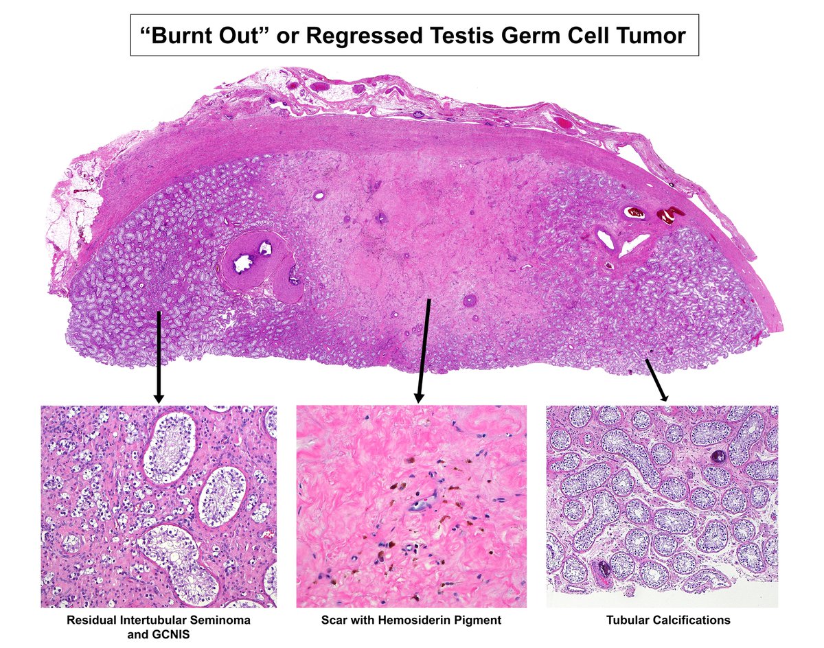 🔬Case of a "Burnt Out" or Regressed Germ Cell Tumor: 
   ➡️ Fibrous scar (middle) with hemosiderin pigment
   ➡️ Some residual seminoma and GCNIS (left)
   ➡️ Intratubular calcifications (seen focally on right)
#GUpath #Pathology #Testis #TesticularCancer