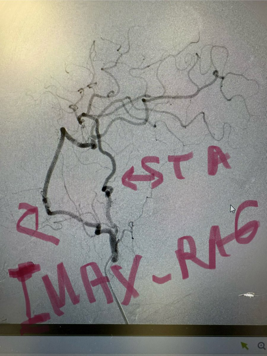 Dr Amir R. Dehdashti (@amirdehdashti) on Twitter photo How do you treat this unusual large MCA #aneurysm with several blister looking irregularities?
Double barrel #bypass using IMAX and STA with only distal occlusion will do it- proximal occlusion intentionally avoided to keep the last lenticulostriate open. <a href="/cvsection/">CV Section</a> <a href="/dgolubMD/">Danielle Golub, MD, MSCI</a> How do you treat this unusual large MCA #aneurysm with several blister looking irregularities?
Double barrel #bypass using IMAX and STA with only distal occlusion will do it- proximal occlusion intentionally avoided to keep the last lenticulostriate open. <a href="/cvsection/">CV Section</a> <a href="/dgolubMD/">Danielle Golub, MD, MSCI</a>