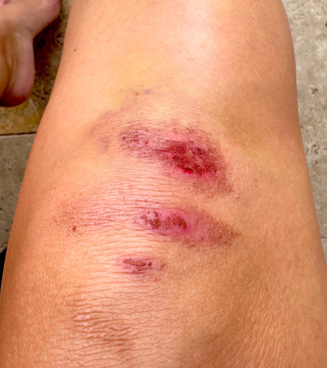 This is gonna scar. Achievement unlocked morning 1 of our spontaneous beach trip for the twinsie bday boys, Bug &amp; cousin. 9 hours sleep, no booze, just a flip flop catching on a stair &amp; trying not to eat the next step with my face so knees took one for the team. 😫😬