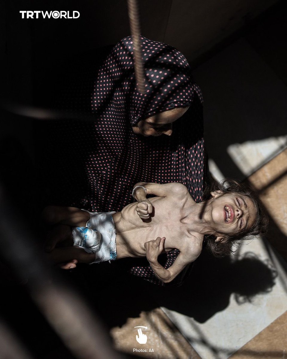 Name: Misk al Madhoun 
Diagnosis: Malnutrition 
Place of residence: Gaza
Reasons: Israeli blockade