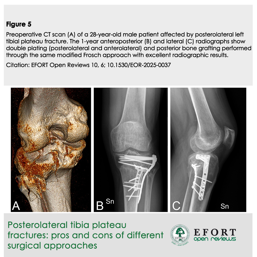 New in #EOR: Tackling tough posterolateral #TibialPlateauFractures! 🦵🦴

 Review compares surgical approaches (Lobenhoffer, Frosch &amp; more). Essential for optimal reduction &amp; fixation, minimizing complications

🔗bit.ly/EOR0525

#EFORT #KneeInjury #FractureFixation