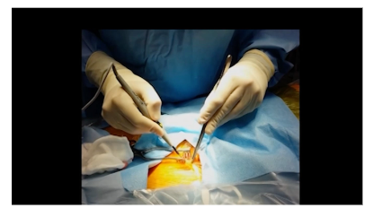 Heart Surgery Forum (@hsfeditor) on Twitter photo 📢 New #Article Published Online
🌷 Title: How We Perform Right Anterior Minimally Invasive Approach for Aortic Valve Replacement
✒️Author: <a href="/SpadaccioDr/">Dr Cristiano Spadaccio</a> , <a href="/Tommaso41126948/">Tommaso Hinna Danesi</a> , <a href="/Carterjglenn/">Carter J. Glenn</a>, Antonio Panza, <a href="/drbypass/">Husam H Balkhy</a> , David Rose
🔔Full Text: lnkd.in/d3shgJR9
#CardiacSurgery 📢 New #Article Published Online
🌷 Title: How We Perform Right Anterior Minimally Invasive Approach for Aortic Valve Replacement
✒️Author: <a href="/SpadaccioDr/">Dr Cristiano Spadaccio</a> , <a href="/Tommaso41126948/">Tommaso Hinna Danesi</a> , <a href="/Carterjglenn/">Carter J. Glenn</a>, Antonio Panza, <a href="/drbypass/">Husam H Balkhy</a> , David Rose
🔔Full Text: lnkd.in/d3shgJR9
#CardiacSurgery