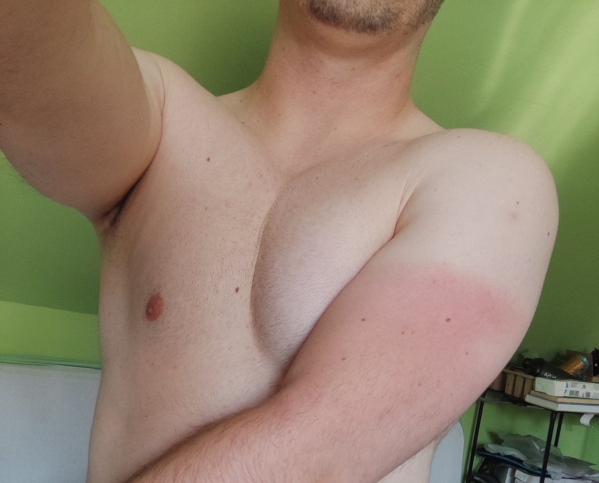 Sunburn 😅😂 in an awfull way... like I still wearing a t-shirt 🤣