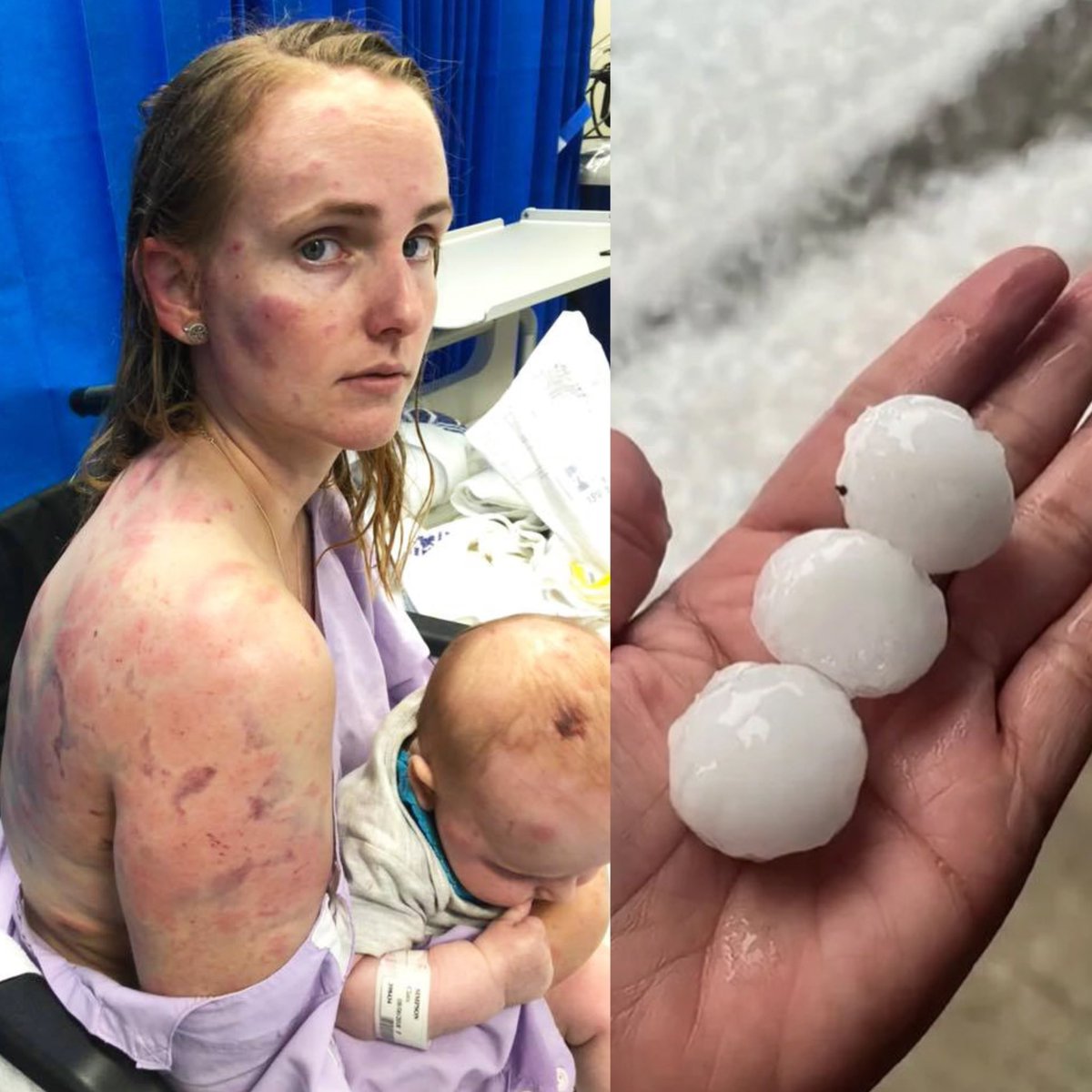 creepydotorg's tweet image. Damage suffered by a young Australian mum after shielding her baby during a violent hailstorm.