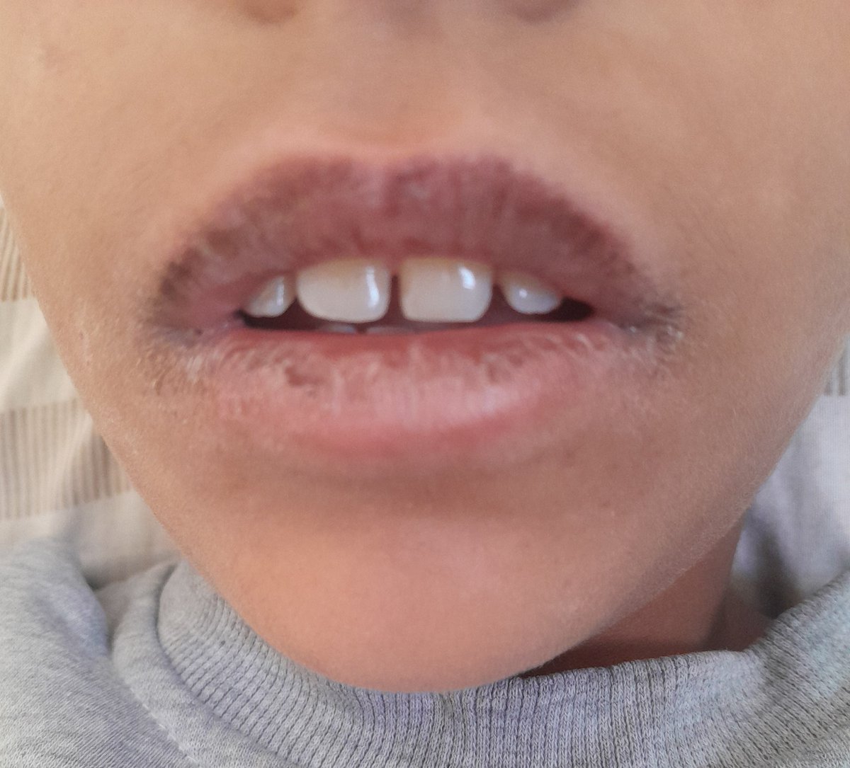 My poor son Mohammed has not eaten for several days. He has become dehydrated and malnourished because of drinking salty water and hunger. His mouth is cracked. Please help my orphan son. I beg you to donate so I can feed him.😭😭😭🙏🙏🙏💔💔
gofund.me/85577ddd