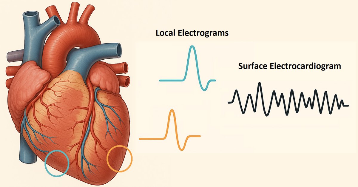Reviews in Cardiovascular Medicine (@rcmjournal) on Twitter photo 🆕 Just published in Reviews in Cardiovascular Medicine:
"Electrophysiology Models for End-Stage Renal Disease Maladaptations That Promote Asystole"
✒️ By Dr. Ike Chinyere <a href="/IkeRChinyere/">Ike Chinyere, MD, PhD</a> (<a href="/uarizona/">University of Arizona</a> University of Arizona; University Medical Center)
💡 This comprehensive review 🆕 Just published in Reviews in Cardiovascular Medicine:
"Electrophysiology Models for End-Stage Renal Disease Maladaptations That Promote Asystole"
✒️ By Dr. Ike Chinyere <a href="/IkeRChinyere/">Ike Chinyere, MD, PhD</a> (<a href="/uarizona/">University of Arizona</a> University of Arizona; University Medical Center)
💡 This comprehensive review