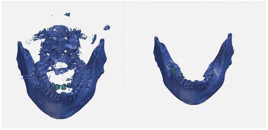 📢 Read our recent publication:

Prevalence, Characteristics, and Dynamics of Mandibular Tori in a Southern German Population: A #ConeBeamComputedTomographic Analysis mdpi.com/3424908 #mdpioral via <a href="/Oral_MDPI/">Oral MDPI</a> 

#toru #mandibular #computedtomography #CBCT