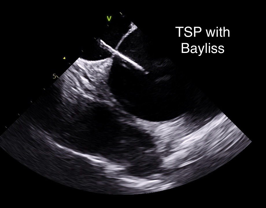A new landscape for LAAO in the UK:
increasing pressure on GA slots TOE guided  approach is becoming less feasible. At NUH we’ve streamlined the pathway ; CT for pre-procedural planning, ICE or mini TOE probes for the procedure—enabling a more efficient, patient-centred approach