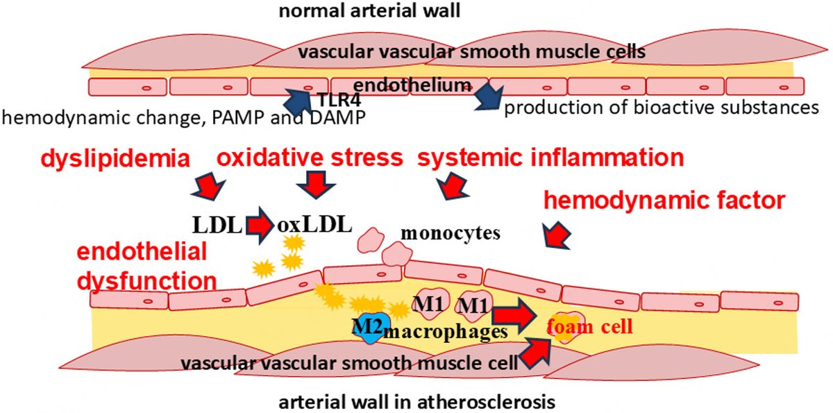 Vessel Plus (@vessel_plus) on Twitter photo 🥳Fresh off the oven!
🧬Review: Atherosclerosis and its immune mechanisms by <a href="/DrKotlyarov/">Stanislav Kotlyarov</a>
Immunotherapy targeting macrophages and T cellsshows promise for future treatments.
🔗 oaepublish.com/articles/2574-…
🩺#Atherosclerosis #Immunotherapy #cardiotwitter 🥳Fresh off the oven!
🧬Review: Atherosclerosis and its immune mechanisms by <a href="/DrKotlyarov/">Stanislav Kotlyarov</a>
Immunotherapy targeting macrophages and T cellsshows promise for future treatments.
🔗 oaepublish.com/articles/2574-…
🩺#Atherosclerosis #Immunotherapy #cardiotwitter