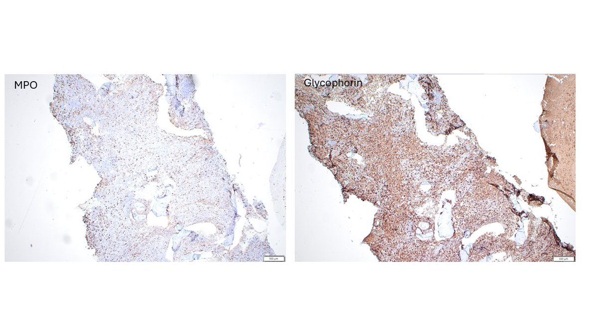 StephenStalls's tweet photo. Case of evolving acute erythroid leukemia, apparent null P53 among pronormoblasts. Genetics showed complex karyotype including deletion 17p as well as TP53 mutation causing premature truncation. #pathTwitter #pathology #hemepath #molpath https://t.co/sXbToHdMn1
