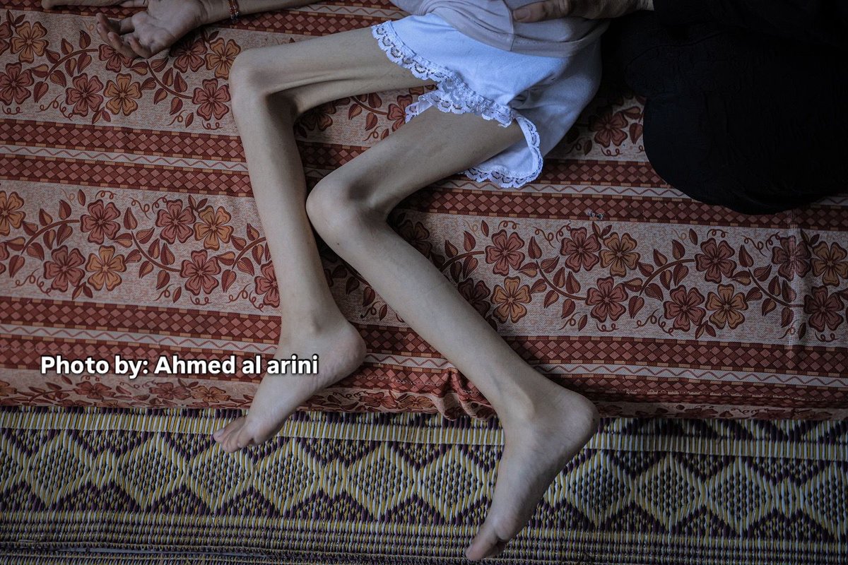 AnasAlSharif0's tweet photo. طفلة فلسطينية تبلغ من العمر 9 سنوات غير قادرة على المشي بسبب سوء التغذية الحاد

مدينة غزة،  – 31 يوليو 2025: مريم عبد العزيز محمود دواس، الطفلة البالغة من العمر 9 سنوات، والتي لجأت مع أسرتها إلى مركز إيواء نتيجة العدوان الإسرائيلي المستمر، أصبحت غير قادرة على المشي بسبب سوء التغذية الحاد في مدينة غزة. كانت مريم تزن 25 كيلوغرامًا قبل التصعيد، إلا أن وزنها انخفض إلى 10 كيلوغرامات فقط. وكشفت الفحوصات الطبية في المستشفى عن عدم وجود أي مرض عضوي، وأكد الأطباء أن حالتها ناجمة فقط عن الجوع وسوء التغذية. وتناشد أسرتها الجهات المعنية بسرعة إخلائها طبيًا وتوفير الدعم الغذائي اللازم لإنقاذ حياتها.