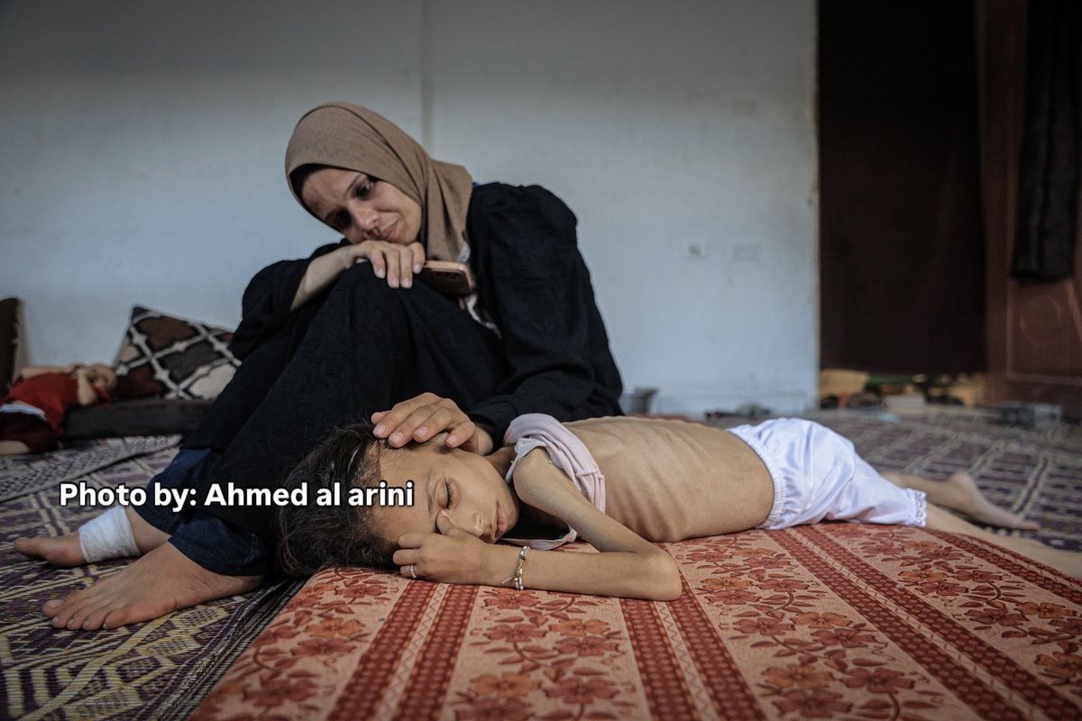 طفلة فلسطينية تبلغ من العمر 9 سنوات غير قادرة على المشي بسبب سوء التغذية الحاد

مدينة غزة،  – 31 يوليو 2025: مريم عبد العزيز محمود دواس، الطفلة البالغة من العمر 9 سنوات، والتي لجأت مع أسرتها إلى مركز إيواء نتيجة العدوان الإسرائيلي المستمر، أصبحت غير قادرة على المشي بسبب سوء