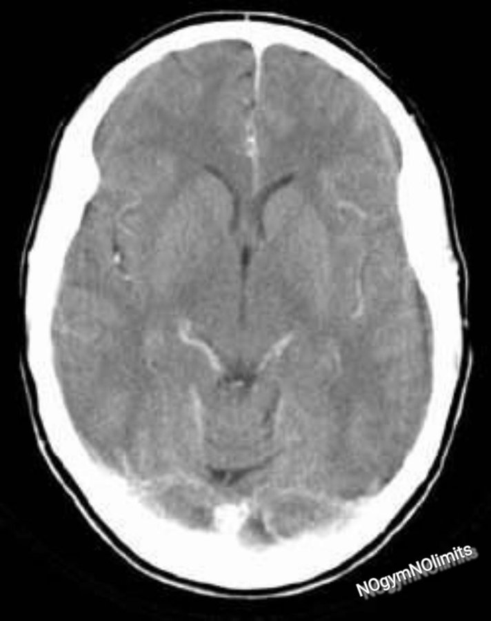 ¿Y si te dijera que hay una proteína que mejora tu memoria, te protege de la ansiedad y ni siquiera sabes que existe?

Te lo cuento: