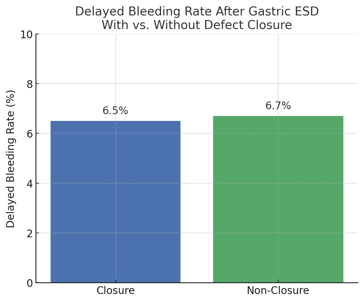 Daryl Ramai, MD, MPH, MSc. (@darylramai) on Twitter photo 🚨 New Study: Gastric ESD & Delayed Bleeding - Is defect closure worth it? 🤔
🔍N=135
📉Bleeding: 6.7% w/ closure vs 6.5% w/o
🛠 Closure: Overstitch, X-Tack, clips
🧠Routine closure? Maybe not
🩺Selective use = high risk 🤒
👉pubmed.ncbi.nlm.nih.gov/40707748/
<a href="/A_Qatomah/">Abdulrahman Qatomah عبدالرحمن قطومه</a> <a href="/ThirdspaceEndo/">Hiroyuki Aihara, MD, PhD</a> 🚨 New Study: Gastric ESD & Delayed Bleeding - Is defect closure worth it? 🤔
🔍N=135
📉Bleeding: 6.7% w/ closure vs 6.5% w/o
🛠 Closure: Overstitch, X-Tack, clips
🧠Routine closure? Maybe not
🩺Selective use = high risk 🤒
👉pubmed.ncbi.nlm.nih.gov/40707748/
<a href="/A_Qatomah/">Abdulrahman Qatomah عبدالرحمن قطومه</a> <a href="/ThirdspaceEndo/">Hiroyuki Aihara, MD, PhD</a>