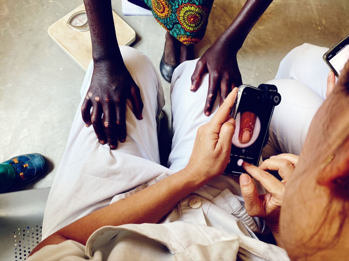 With support from a DermLink grant, a project organised by Dermalawi reached over 7,000 patients! Find out more about Dermalawi's collaboration between professionals from Malawi and Spain, who is dedicated to improving dermatological care in Malawi: bit.ly/dermlink-proje…