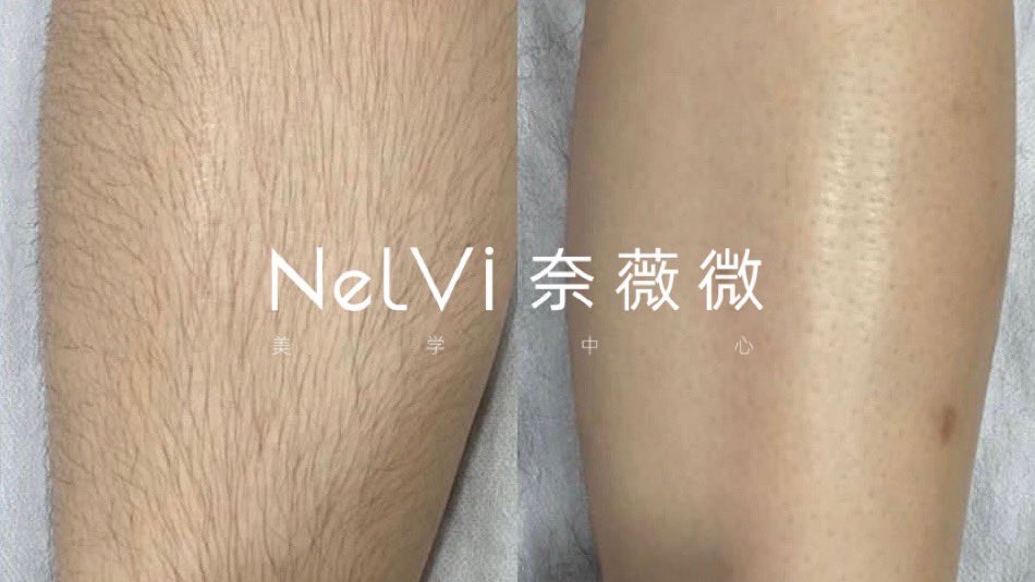 旺仔厦门专业男士脱毛【可互推】 tweet media