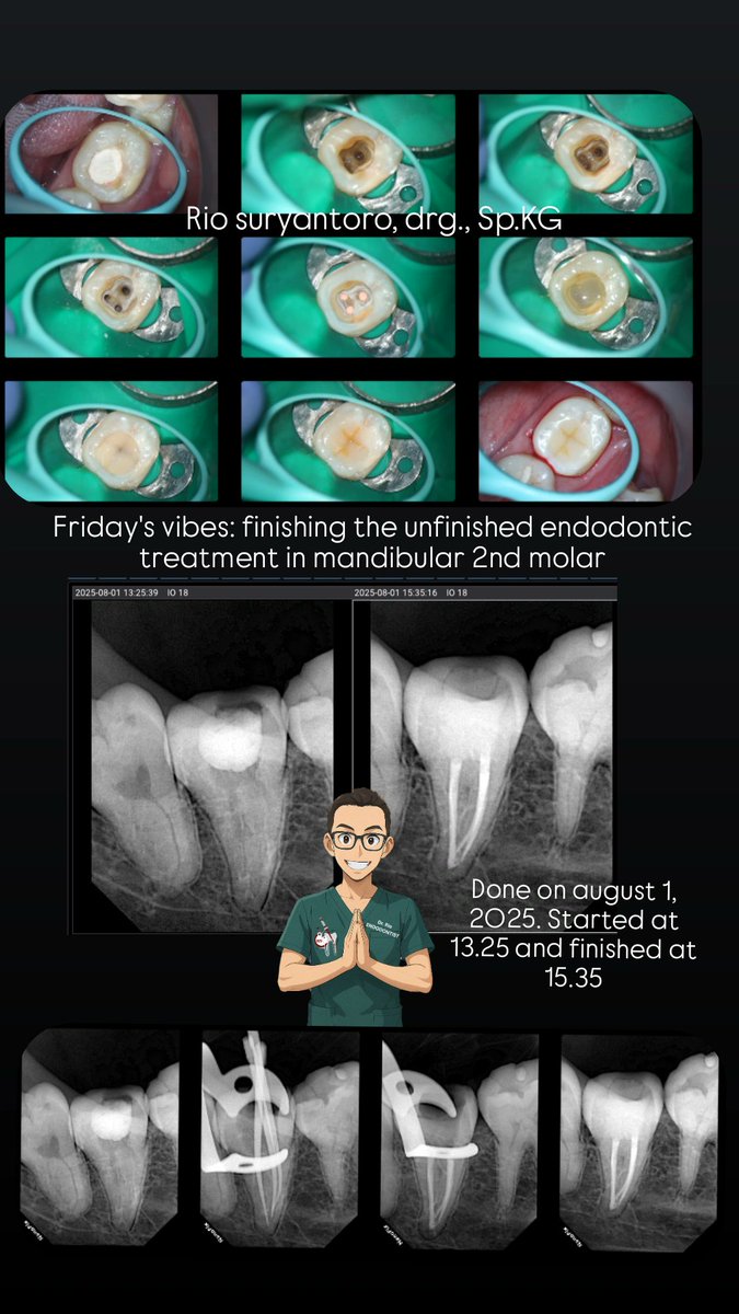 Friday's vibes: finishing the unfinished endodontic treatment in mandibular 2nd molar.
Done on august 1, 2025. Started at 13.25 and finished at 15.35.