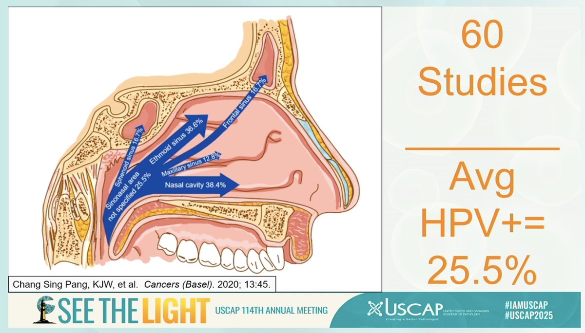 #USCAP with Dr James Lewis 

We know to test all oropharyngeal cancers for HPV but what about ✨sinonasal✨? --> recommendation to also test these for HPV  (25% associated w/HPV)

Mechanism? pharyngeal reflux, so still thought to be sexually transmitted

#PathWebinarPearls