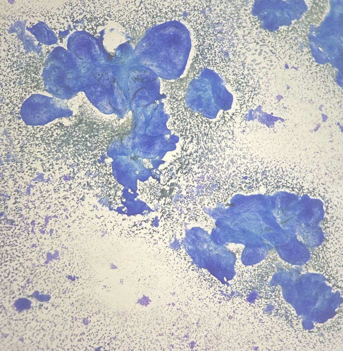 16 year old girl presented with lateral cervical neck swelling , 2x2cm for one month.
#cytopathology
#papillarycarcinomathyroid 
#Mets