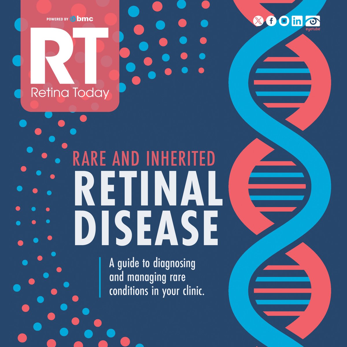 RetinaToday's tweet photo. Rare and inherited retinal diseases challenge patients and clinicians alike—but innovation and perseverance are driving new hope. Explore the latest breakthroughs, case studies, and expert insights in the July/August issue of Retina Today. Read now at https://t.co/Q414UvJ749 https://t.co/YVvkUszEL7