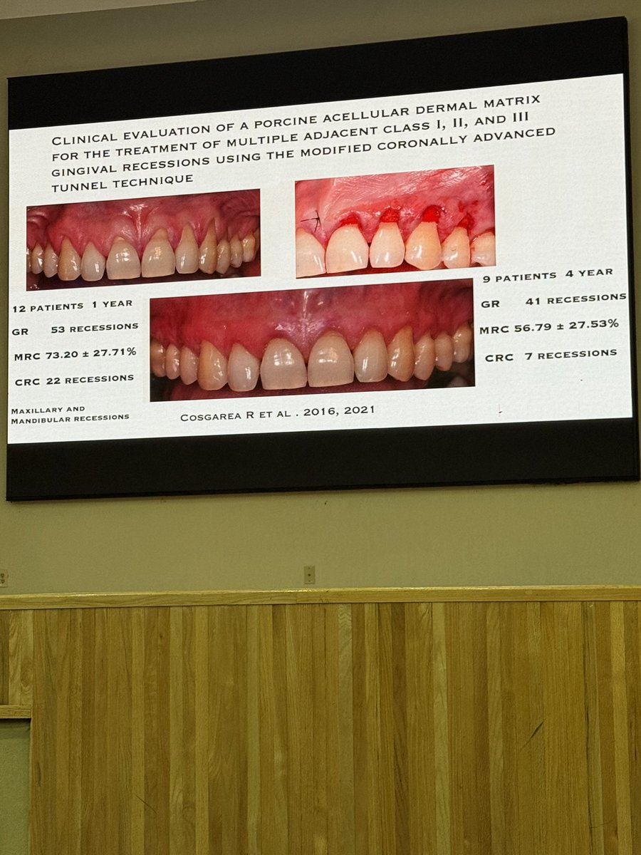 PerioMX's tweet image. En comparaciones clínicas nos muestran que recesiones tratadas con matrices dérmicas acelulares tanto en maxilar y mandibula nos dan la validez de su uso