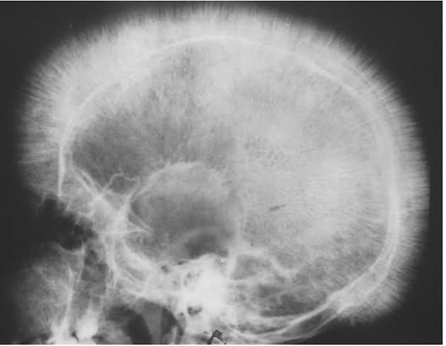Young boy with need of recurrent blood transfusions.

What's the Diagnosis?
