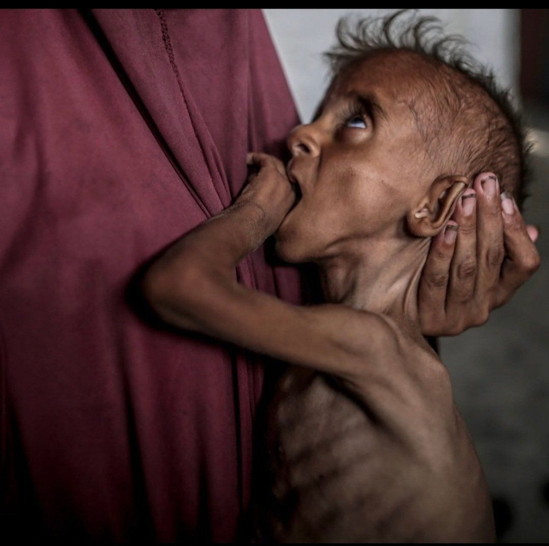 في غزة، الجوع يعض أجساد الأطفال.
يضعون أيديهم في أفواههم... لا طعام، لا دواء، فقط وجع يراه العالم ويسكت.