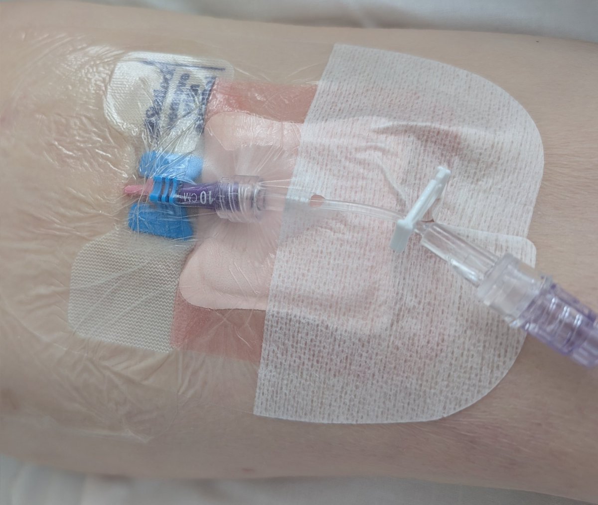 Minimidline PowerglidePro 20G 10 cm  en MID.
Puede ser una opción en pacientes caqueticos y frágiles con pronóstico de vida muy limitado. En este caso el acceso en MMSS no era posible por friabilidad de los tejidos y presencia de múltiples lesiones. D