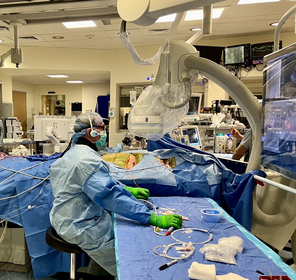 Jeffrey M Vinocur (@jeffrey_vinocur) on Twitter photo #EPeeps “Just a PVI”
<a href="/jfreeMD/">James V. Freeman</a> making it look easy with left transhepatic transseptal access and left internal jugular ICE.
My contribution was to cannulate the CS. Antegrade from groin to interrupted IVC to right hemiazygos to persistent right SVC. #EPeeps “Just a PVI”
<a href="/jfreeMD/">James V. Freeman</a> making it look easy with left transhepatic transseptal access and left internal jugular ICE.
My contribution was to cannulate the CS. Antegrade from groin to interrupted IVC to right hemiazygos to persistent right SVC.