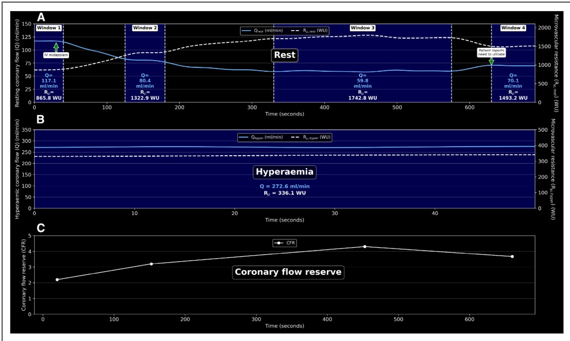 Are "resting" coronary physiology measurement reliable? <a href="/MahendiranThabo/">Thabo Mahendiran</a> <a href="/awilgenh/">Adriaan Wilgenhof</a> <a href="/BernardBruyne/">Bernard De Bruyne</a> <a href="/CardioAalst/">Hartcentrum Aalst</a> ahajournals.org/doi/full/10.11…