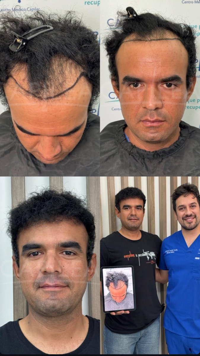 Aviso COFEPRIS 2319012002A00017
#drhectortreviño #capilea #capileamonterrey #hairtrasplant #injertocapilar #microinjertocapilar  #fuetechnique #trasplantecapilar   #capileatijuana #capileacdmx #drhectortrevino #capileamexico #hairtrasplantsurgeon
