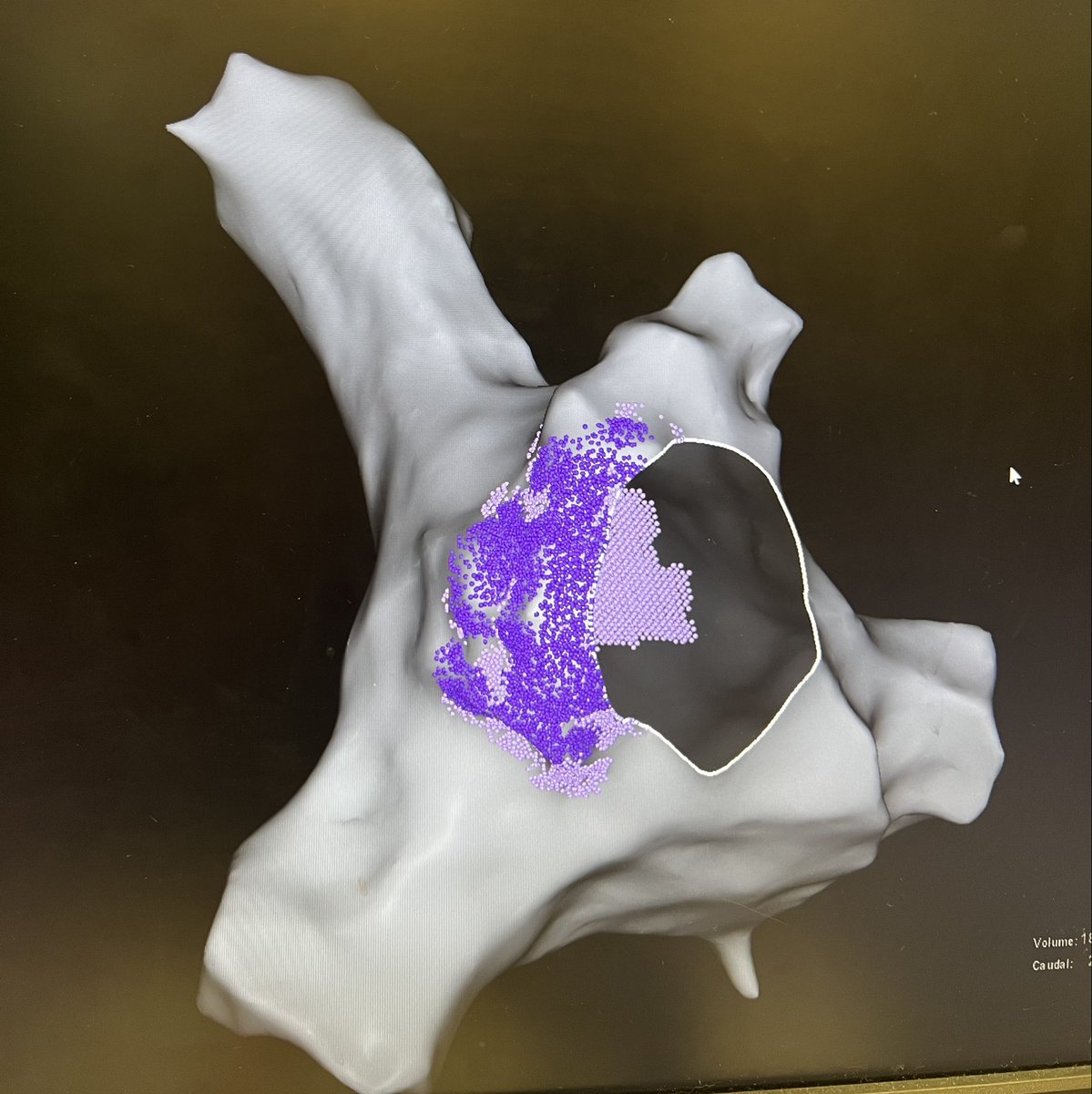 Off roading with #varipulse. 4th ablation for AF. No mappers were tagged in this case !