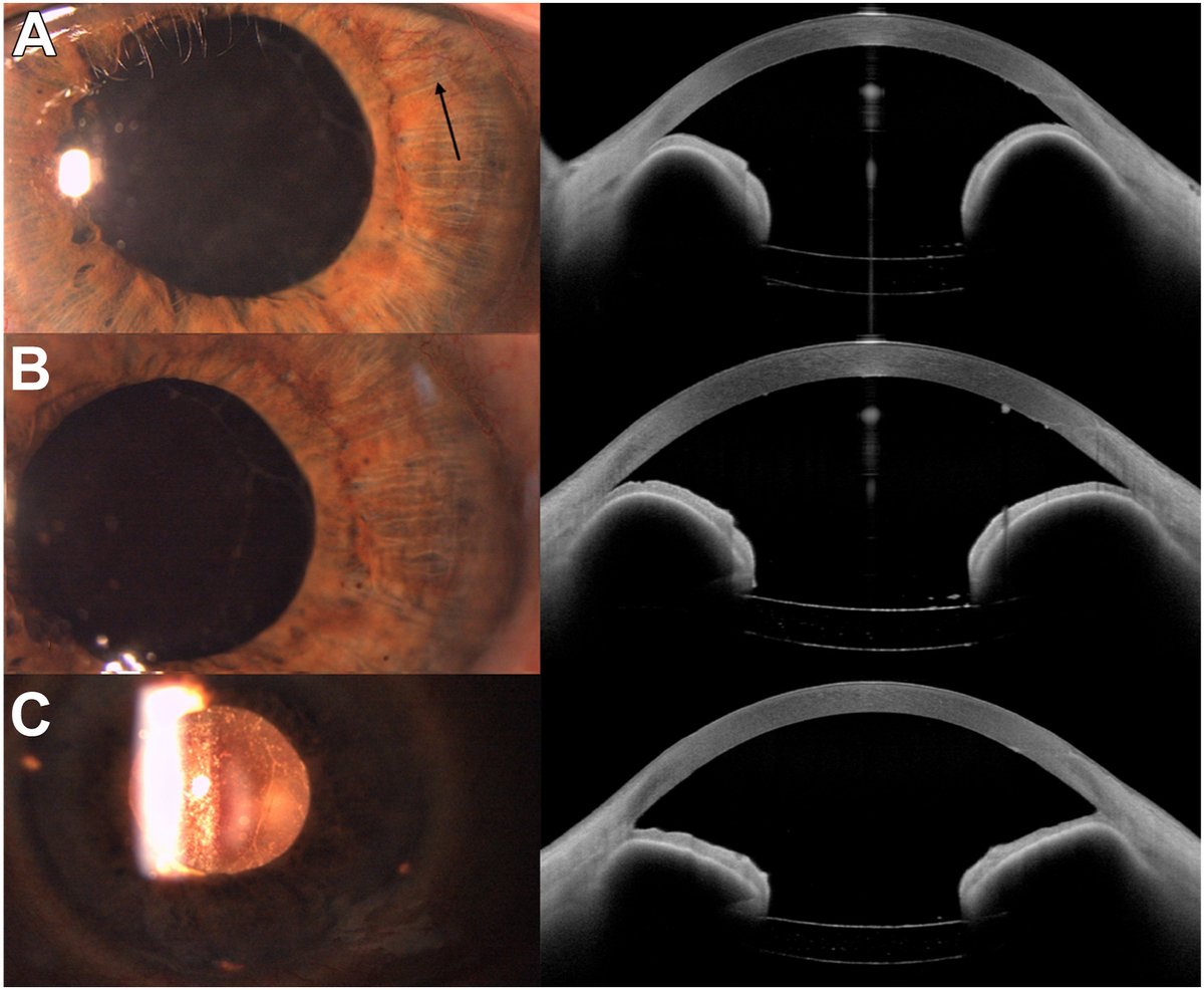 High-Resolution Anterior Segment-OCT-Guided Management of Iris Bombe Due to Pupillary Block
ow.ly/PLsP50Wg1kC 
#ophthalmology #glaucoma
