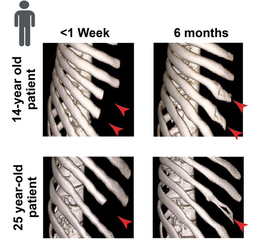 NIH intramural researchers worked with scientists at USC and UCSF to to uncover some of the reasons why rib bones lose their ability to regenerate over time, providing new insights into boosting bone regeneration. bit.ly/456CzwZ