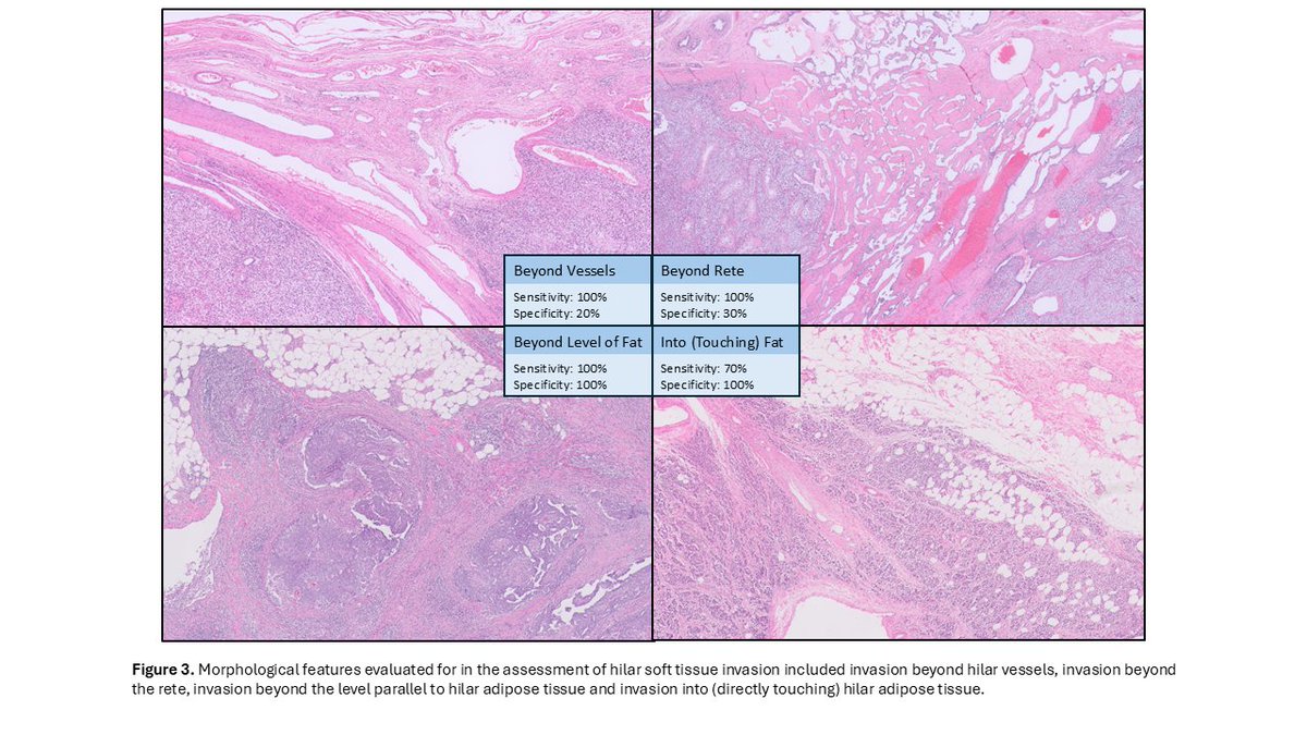 #GUpath orchiectomy for germ cell tumor grossly encroaching hilum:

should top vs bottom row be considered "hilar soft tissue invasion" (HSTI)?  HSTI=pT2, so critical staging parameter!

how should HSTI be defined?

in👇🏽interobserver study, we investigate this and offer some💡