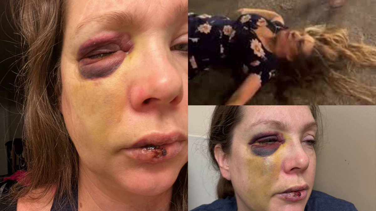I just spoke with Holly, the victim of the Cincinnati mob attack.

She’s a single mom, severely injured, unable to work, and now living in hiding due to threats.

This is her official GiveSendGo. 100% of it goes to her recovery and legal fees to fight back.

Holly tells me: “I