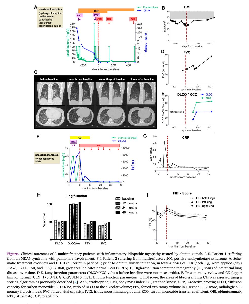 #Obinutuzumab, a humanized anti-CD20 monoclonal antibody with deeper B-cell depleting capacity compared to #rituximab, is a potential treatment for refractory idiopathic inflammatory #myopathies with severe #musculoskeletal and #lung involvement, as demonstrated by the recently