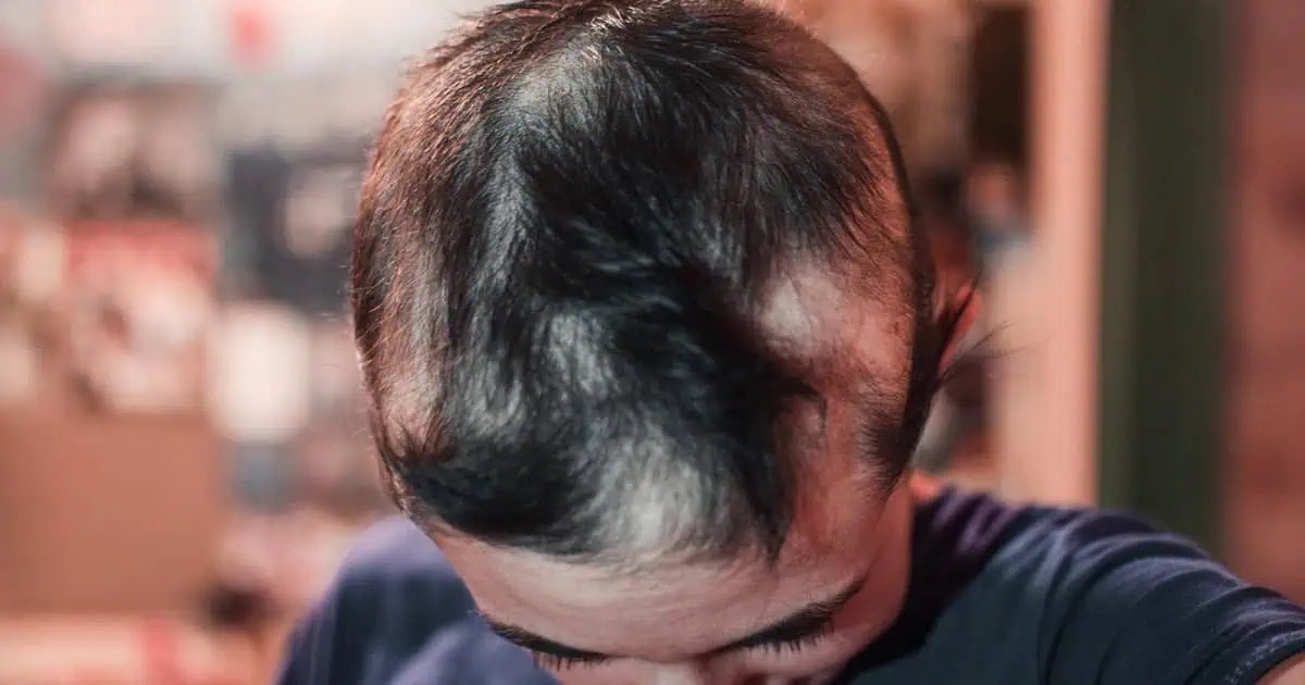 Major Study Links Covid ‘Vaccines,’ Not Infection, to Hair Loss 

A groundbreaking study by South Korean researchers has raised serious concerns about the potential side effects of Covid vaccines, specifically their association with a range of hair loss disorders