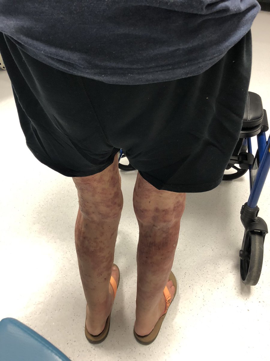 Janetbirdope's tweet photo. #ClinicalPearl
#DRESS vs #subacute #cutaneous #lupus
Pt with well controlled skin from non systemic lupus received
#antibiotics for an #epidural #abscess
How can you tell these 2 #diagnoses apart? https://t.co/cTGLn8Rd12
