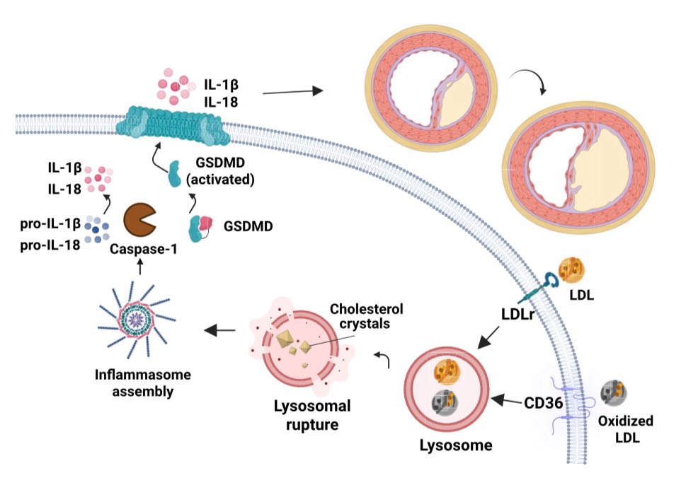 👉Cholesterol Crystals: Not Just a Marker — A Causal Trigger of Vascular Inflammation

☝️A growing body of evidence highlights cholesterol crystals (CCs) as active drivers—not mere bystanders—in the pathogenesis of atherosclerosis.

☝️CCs initiate a cascade of inflammatory events