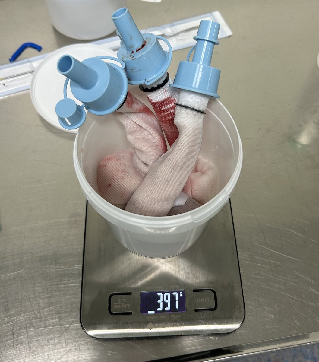 j_garre's tweet photo. Holiday break begins with a new personal record: mission accomplished. 💪
HoLEP 340cc in ECO
🔹 Bilobed technique
🔹 Morcellation under ultrasound guidance due to total bladder occupancy
🔹 Dry weight: 396cc net. Underestimated?
Outstanding teamwork!
#Endourology #HospitaldeMérid https://t.co/J9VTC87mbH