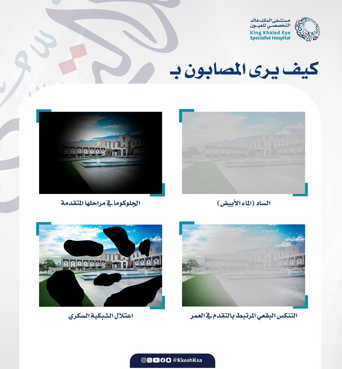 في هذه الصورة نعرض شكلاً تقريبيًا تصوريًا لتأثير بعض أمراض العيون على الرؤية.
قد لا يشعر المصابون في البداية بتغير واضح لكن مع تقدم المرض تصبح الرؤية مشوشة مشوهة أو محدودة كما هو موضح:

#أنتم_بالعيون