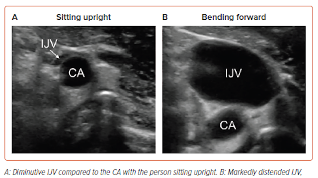 radcliffeCARDIO's tweet image. 📚New #USCJournal Article: "Point-of-care Ultrasound Assessment of the Internal Jugular Vein"

📚 Just Published!

🔓Access it here 👉 ow.ly/mH7t106hItc

@CardioNerds #CVImaging #MedEd